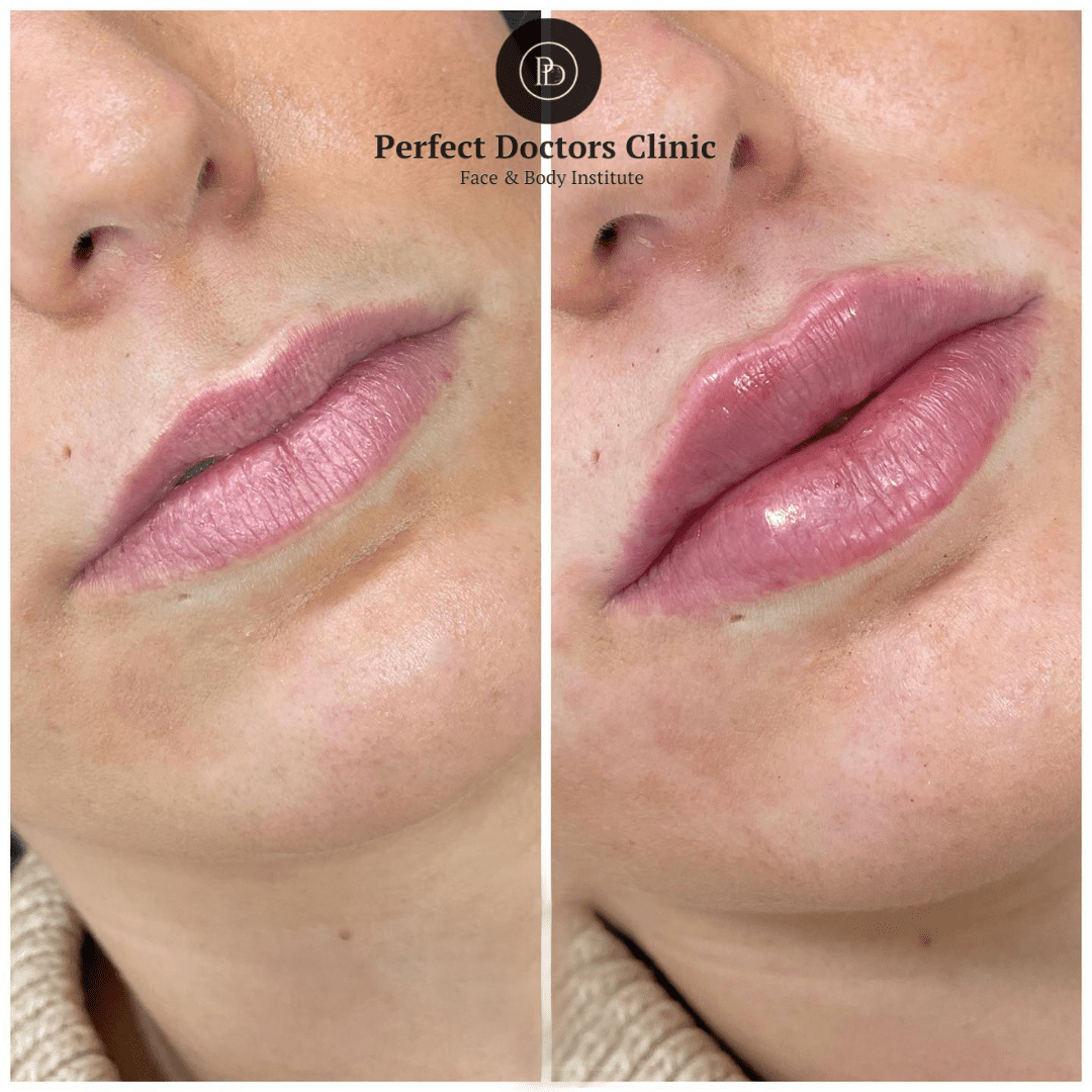 How to Choose Between Juvederm treatments in dubai and Surgery