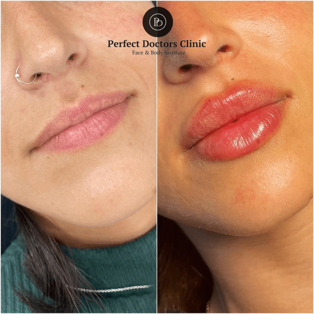 Juvederm for Facial Smoothing: A Guide to Better Skin with the Best Plastic Surgeons in dubai