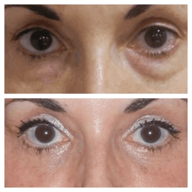 Best Eye bag removal Surgeons in dubai: What Makes a Successful Procedure
