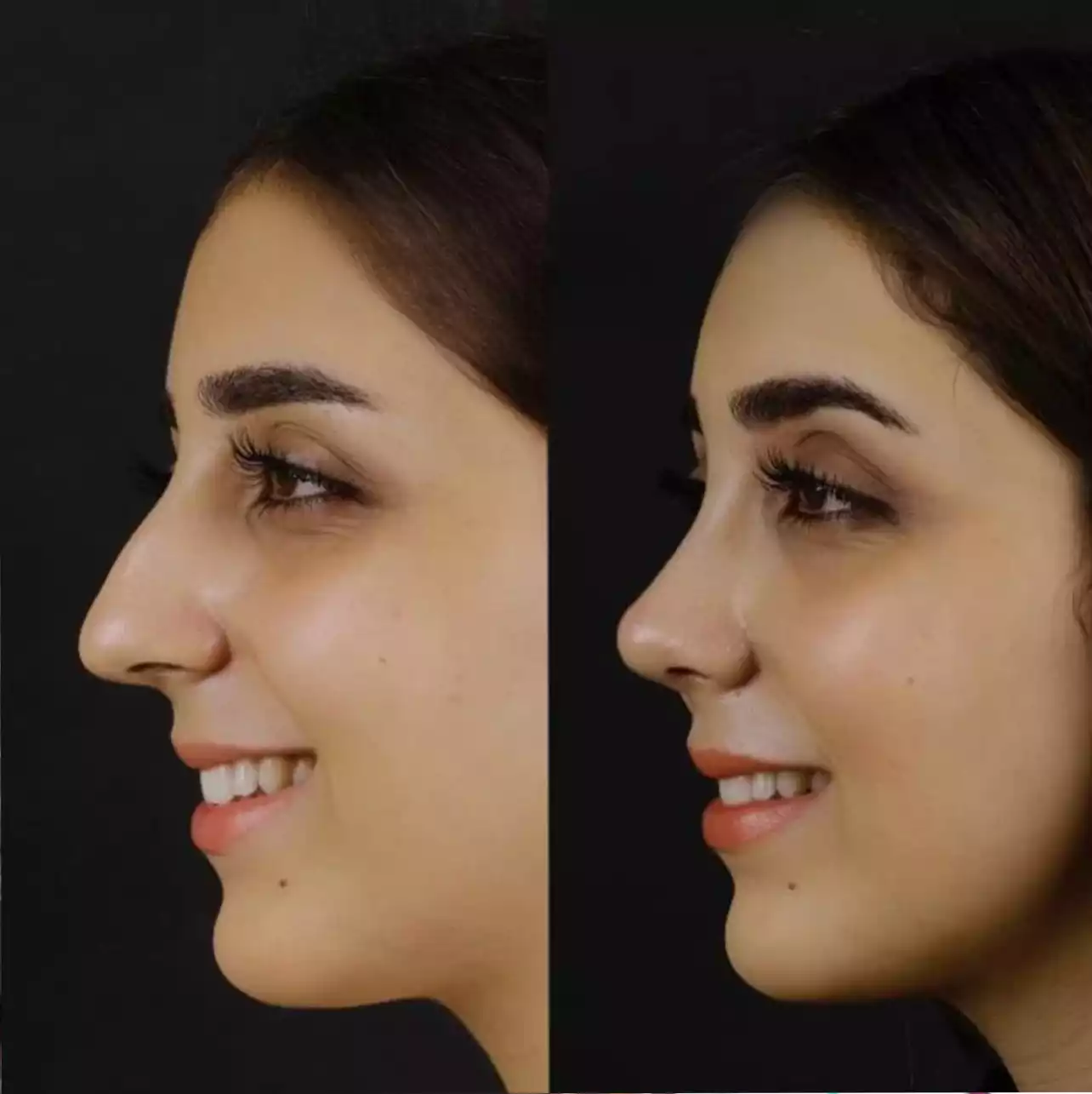 Best Surgeons for Rhinoplasty in Dubai