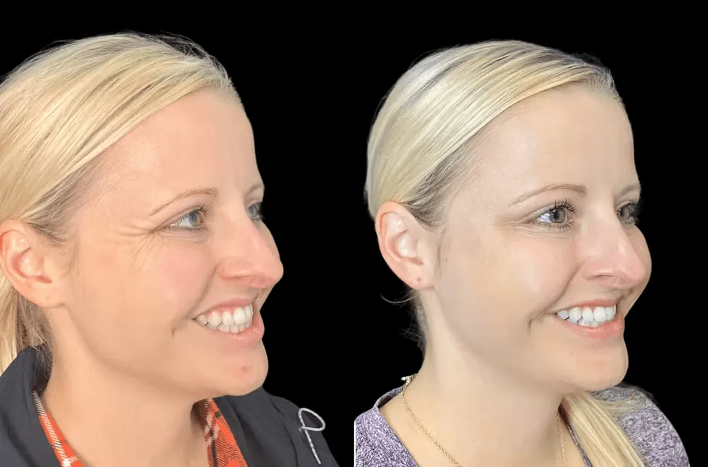 The Ideal Age for Botox in Dubai: When to Start and Why