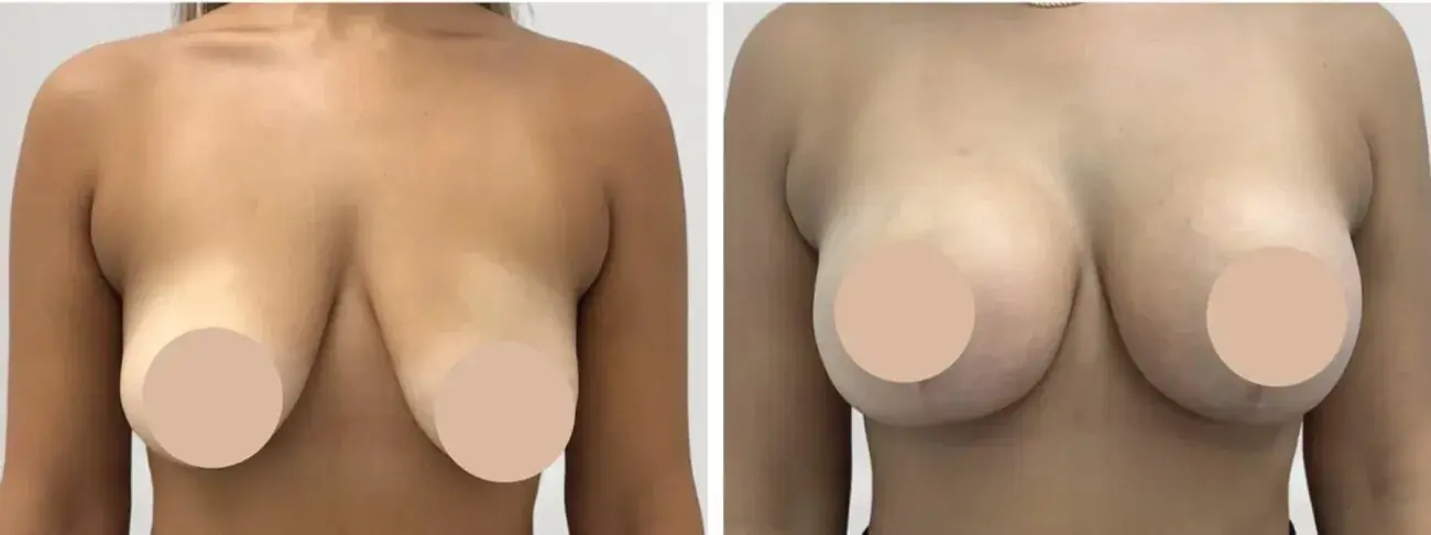 Top Reasons to Consider Breast Reduction in Dubai for Body Proportions