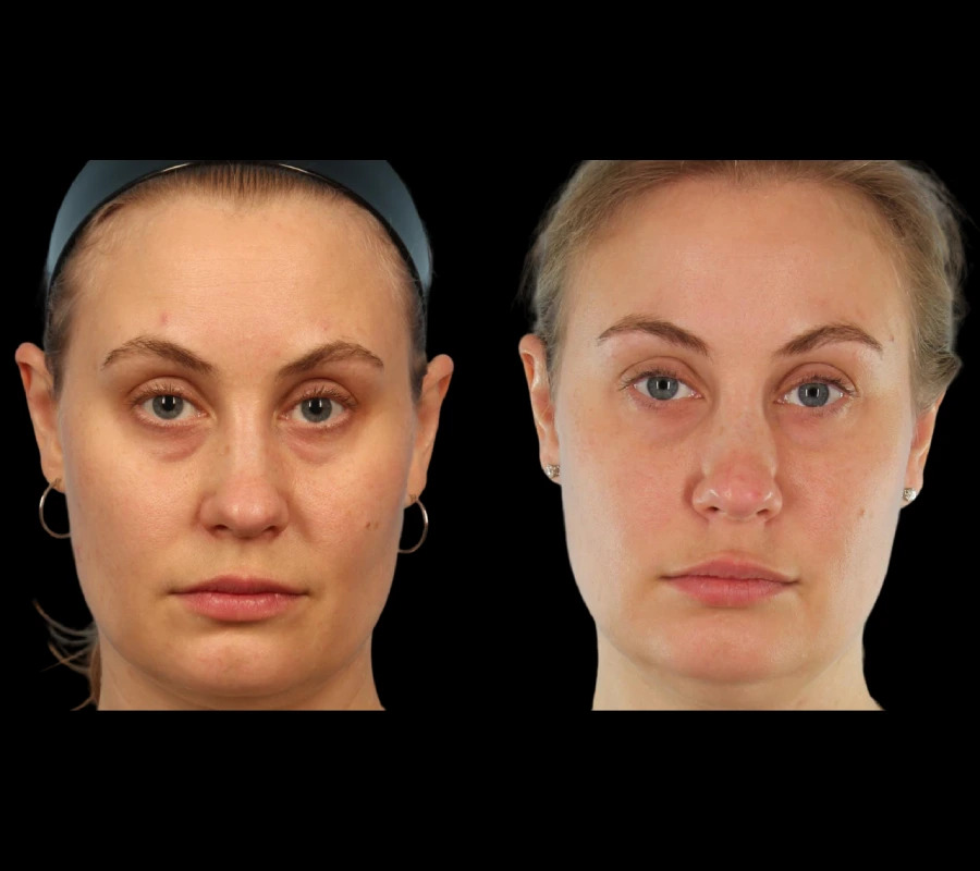 Patient Stories Experiences with Under Eye Fillers in Dubai