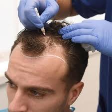 Say Goodbye to Hair Loss with Expert Transplants in New Post