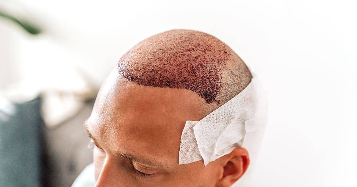 How Much Does A Hair Transplant Cost?