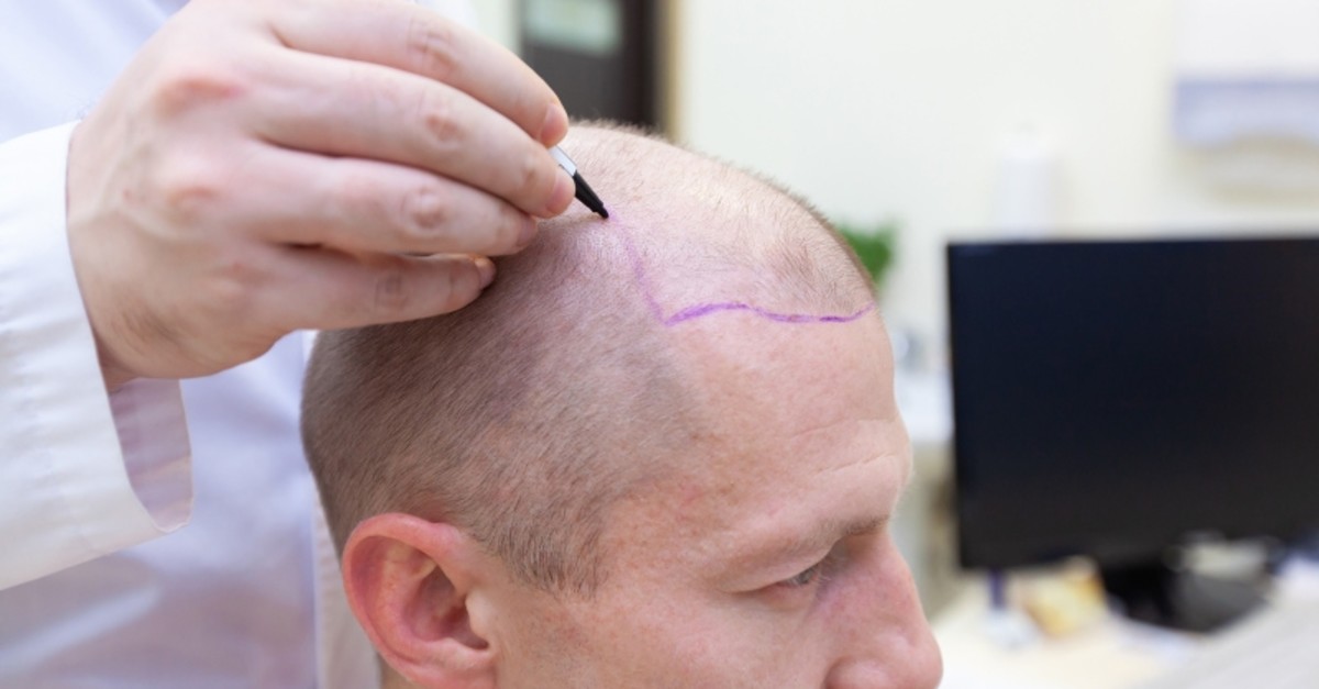 Restore Confidence With Hair Transplant