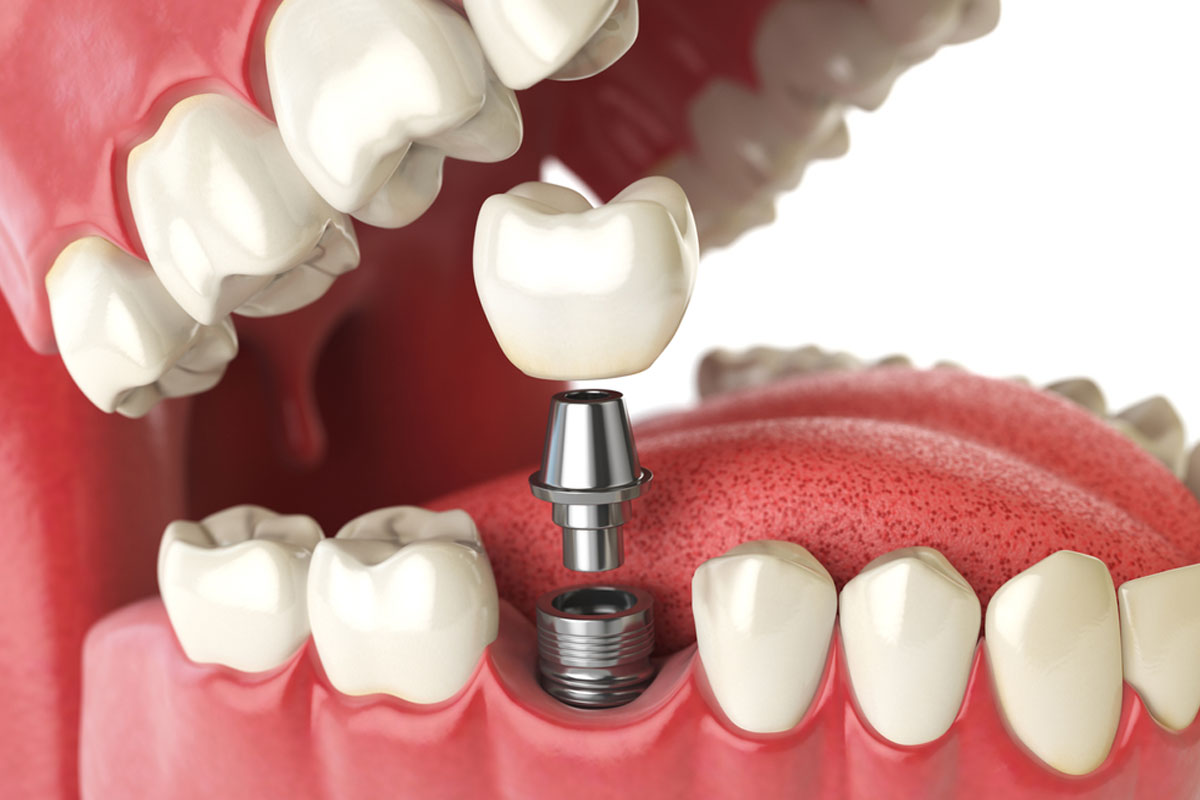 How Do Dental Implants in Dubai Compare to Dentures