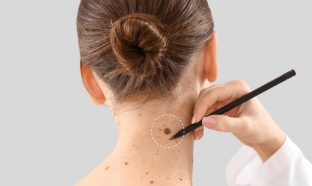 How Does Dubai’s Healthcare Regulation Ensure Safe Skin Tag