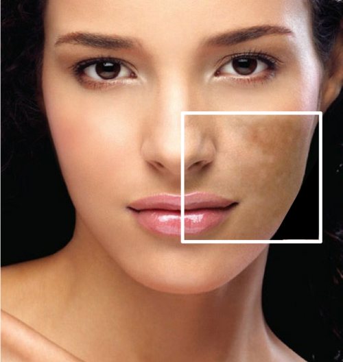 Is Melasma Linked to Stress and Does That Affect Treatment i