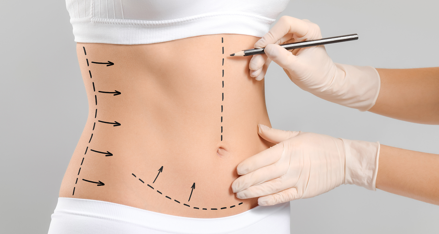 What Is Liposuction? Everything You Need to Know