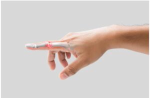 Trigger finger treatment