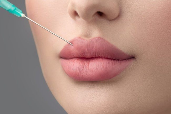 The Top of Natural-Looking Russian Lip Fillers in Dubai