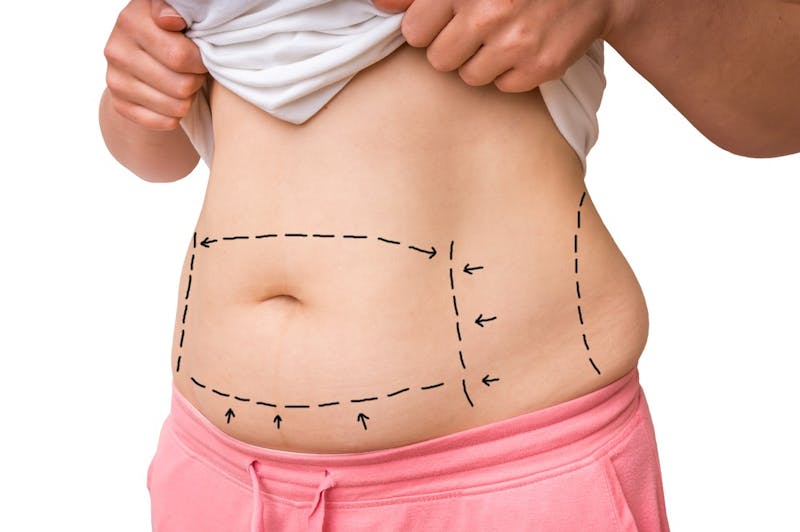 What Happens if I Gain Weight After My Tummy Tuck in Dubai