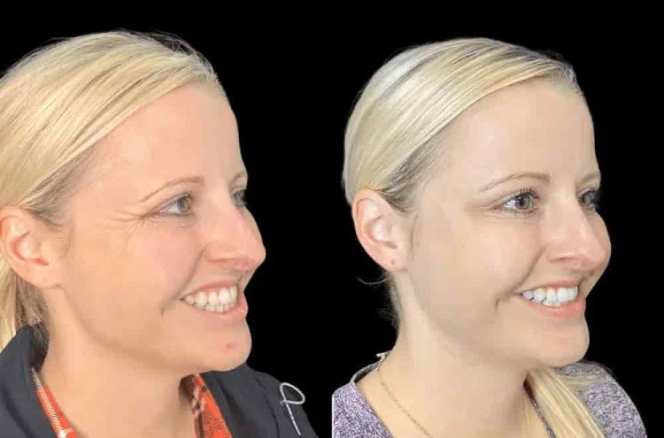 Botox Treatment in Dubai for a Youthful, Refreshed Look