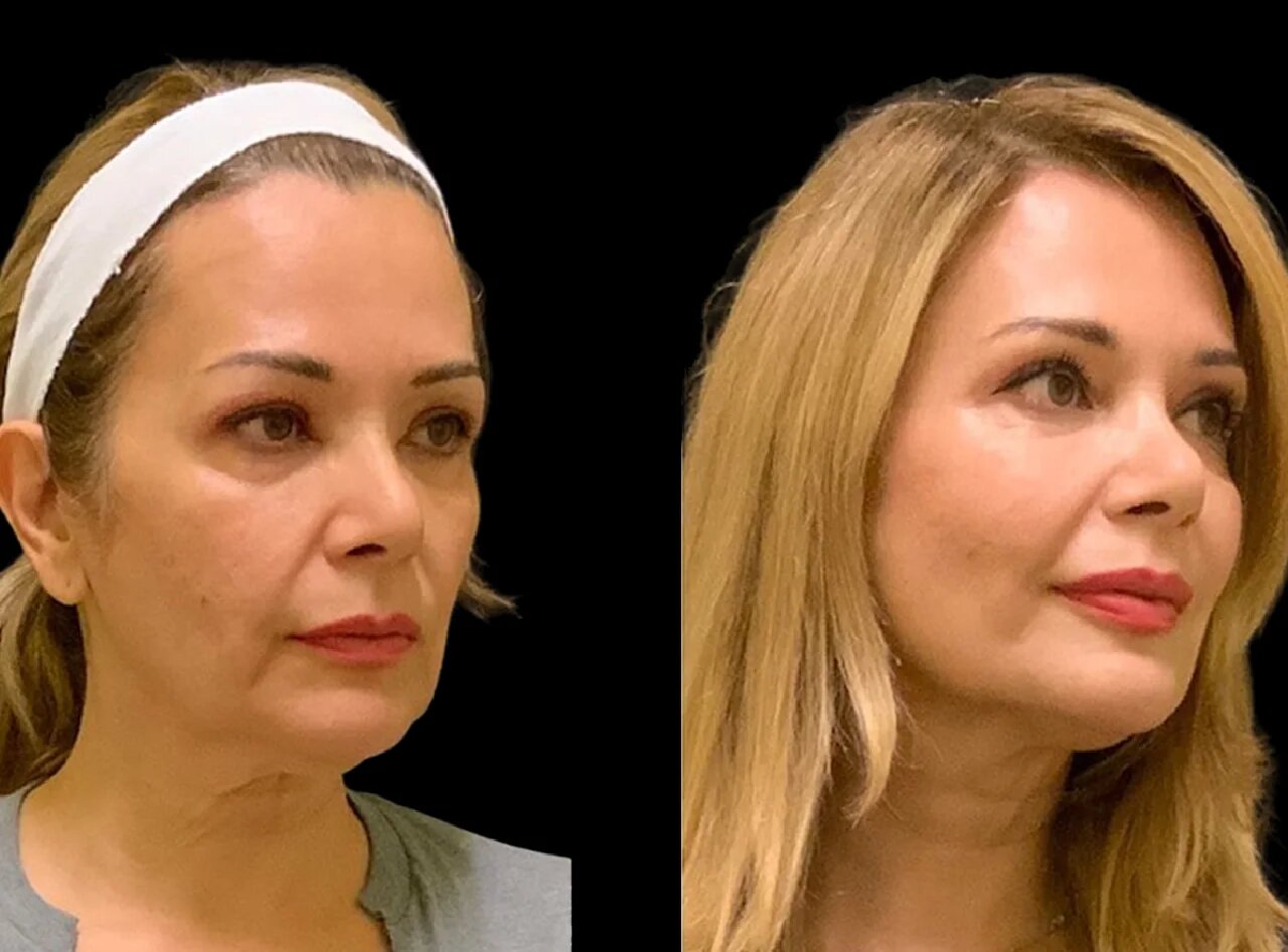 Are Cheek Fillers in Dubai Safe?