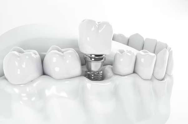 A Comprehensive Guide to Freestanding Dental Implants