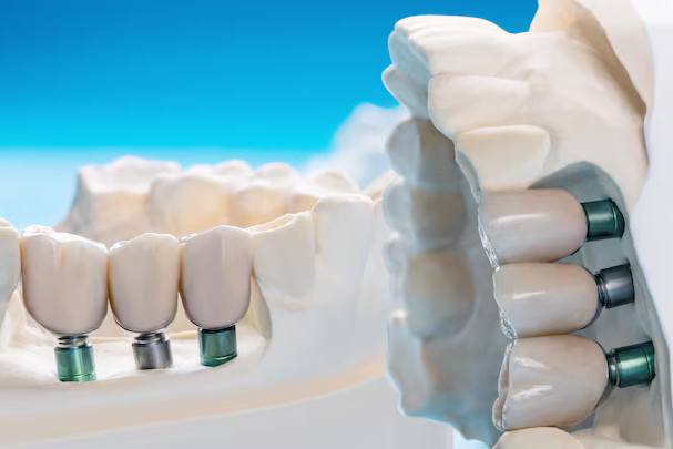 Restoring Dental Function Revolutionize Your Oral Health
