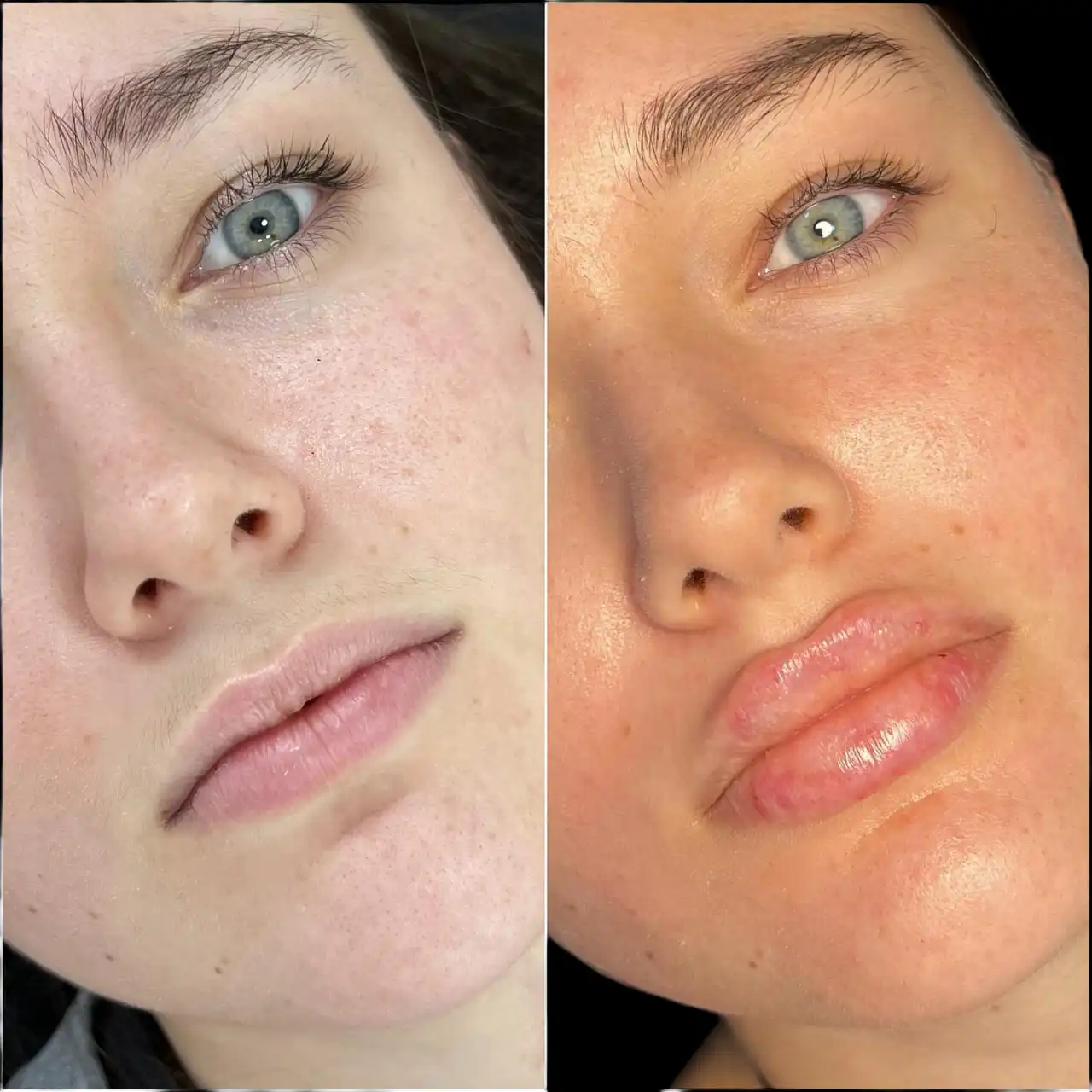Exploring Safe and Effective Fillers Treatments in Dubai