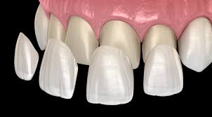 A Step-by-Step Guide to Getting Dental Veneers