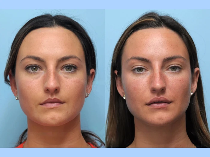 Best Aesthetic Clinics in Dubai for Thread Lift