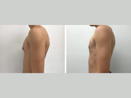 Why Choosing the Best Gynecomastia Surgeon in Dubai Matters for Your Results